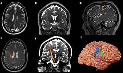 Challenges and Opportunities of Intraoperative 3D Ultrasound With Neuronavigation in Relation to Intraoperative MRI